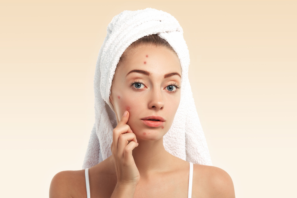 Cum să previi și să tratezi acneea cu ajutorul unor produse naturale și cosmetice